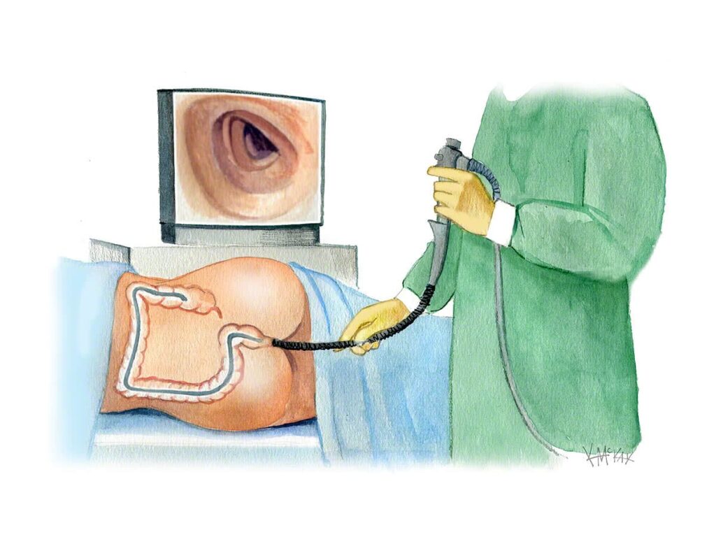 Colonoscopy