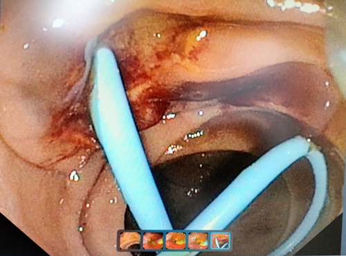 ERCP Procedure In Bilapur