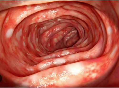 Ulcerative colitis